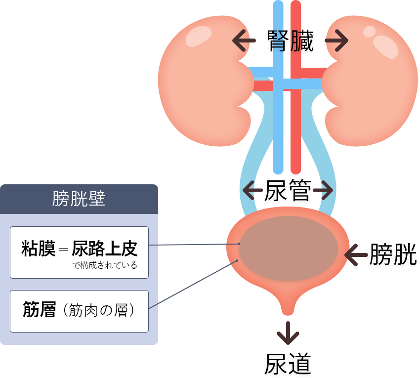 膀胱がんの冒頭画像