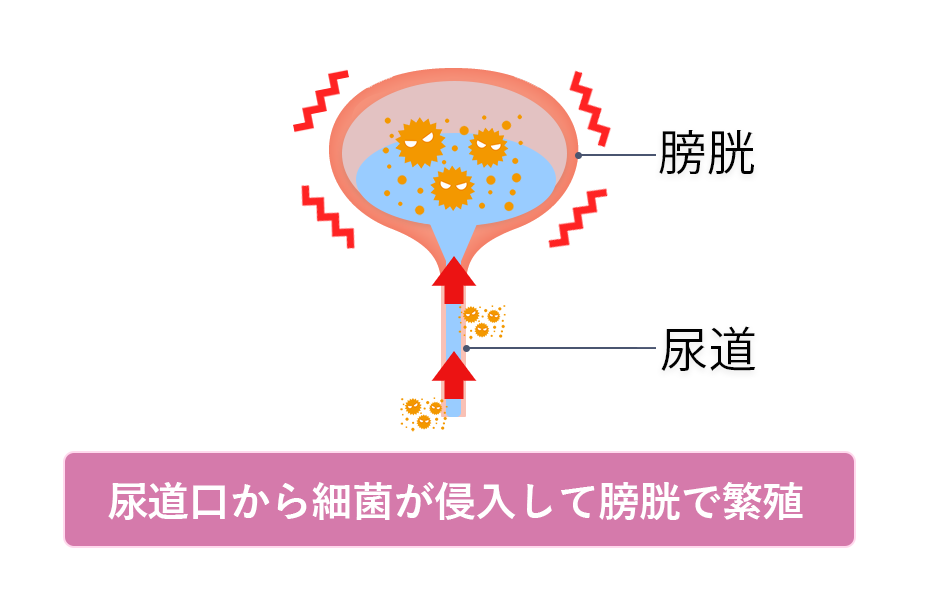 膀胱炎の説明画像